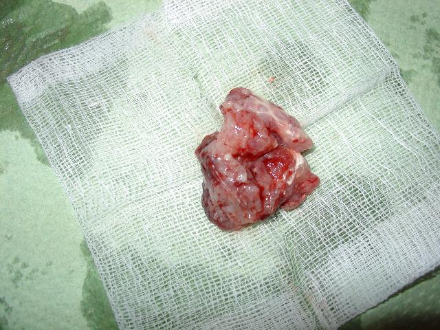 Bauchraumtumor